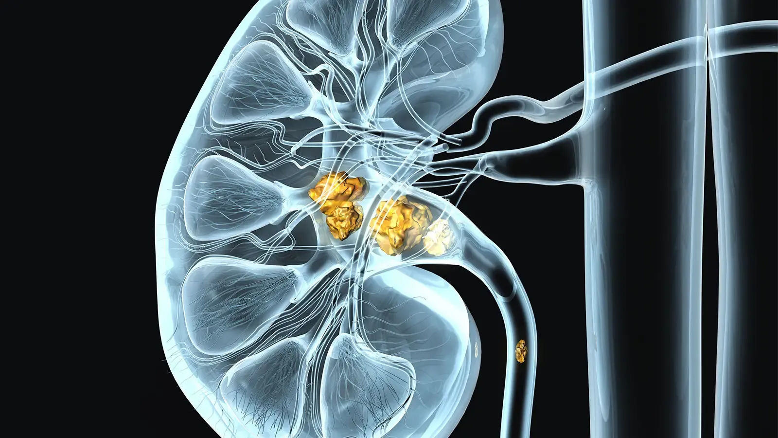 Symptoms of Kidney stones